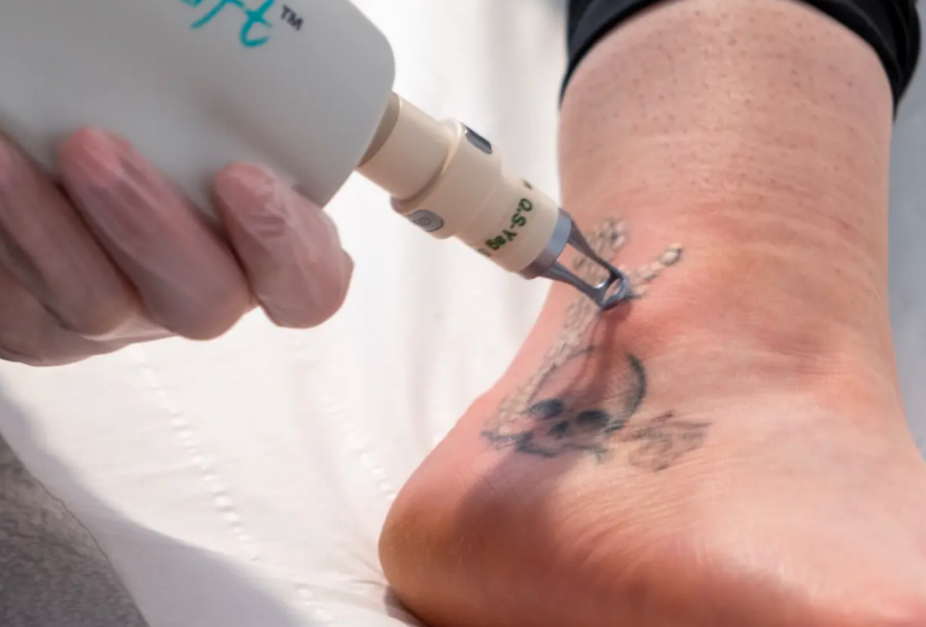 Laser Tattoo Removal: How long until you can see results? — LaserTat