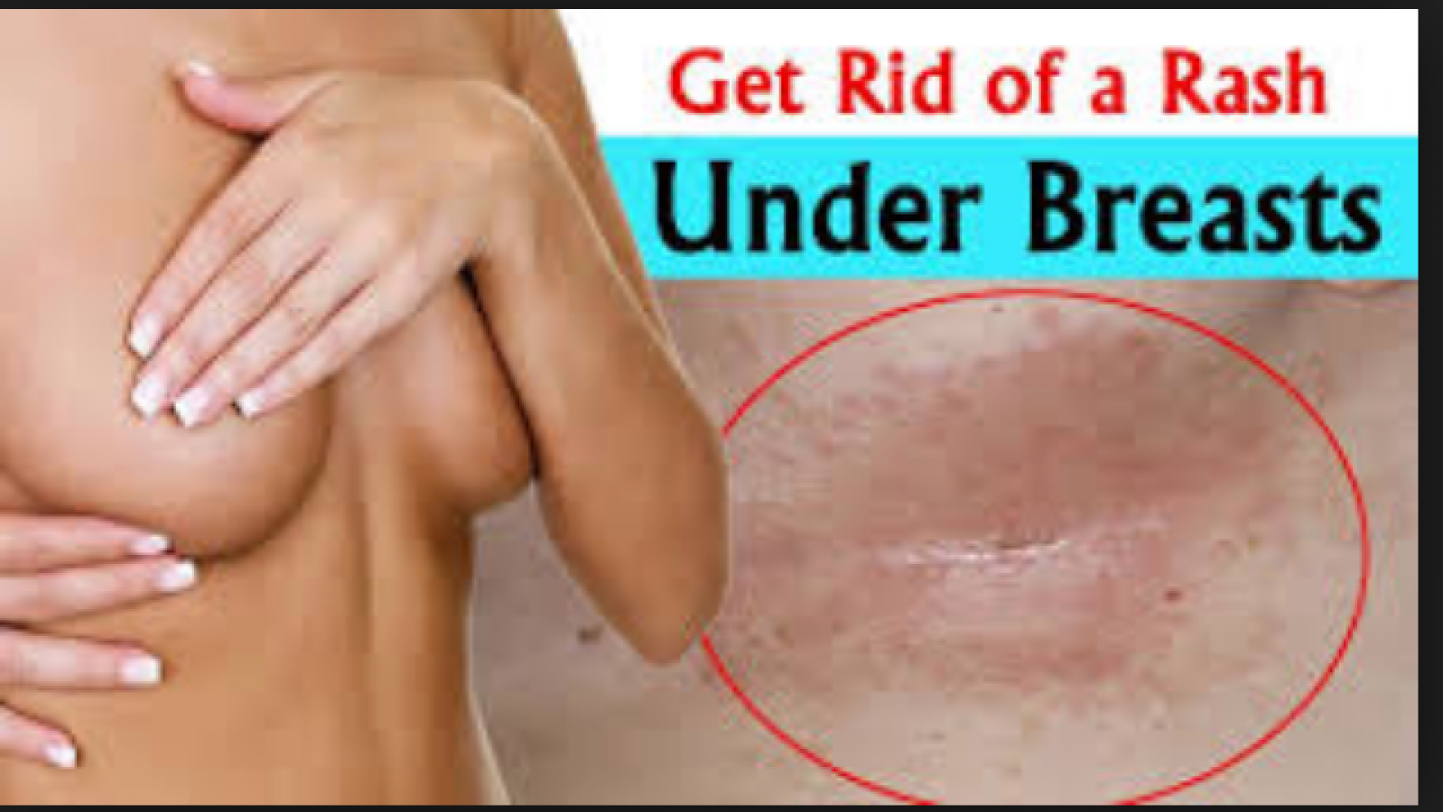 Rashes under breast are common in Summer season; Treat with these home  remedies