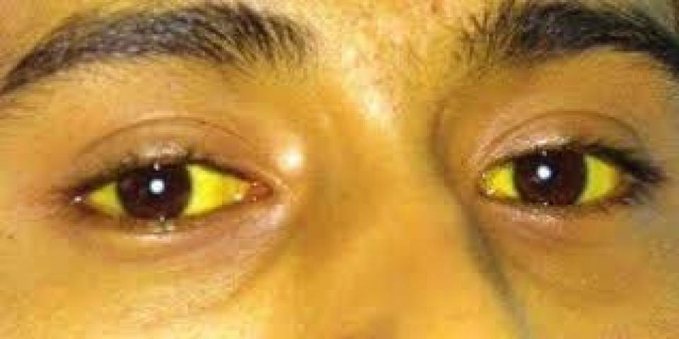 Jaundice - Here's some of the causes and treatments!!!