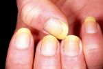Say goodbye to those ugly yellow nails!!!