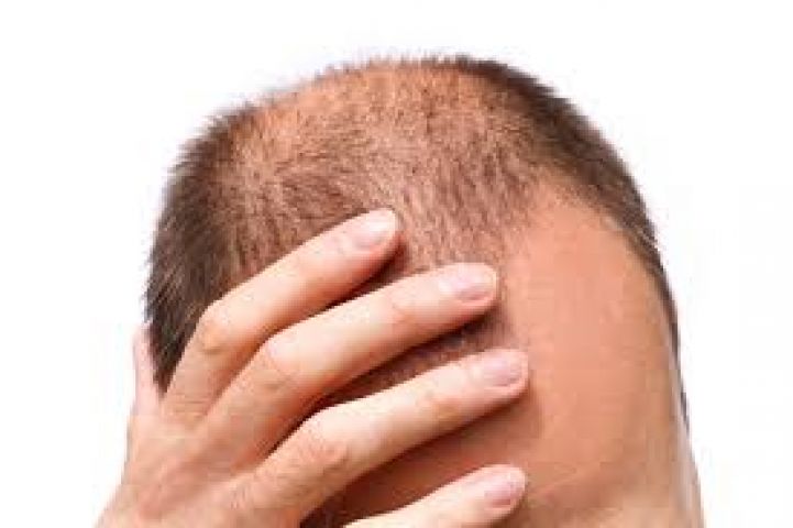 5 Best Foods to Prevent Hair Loss!