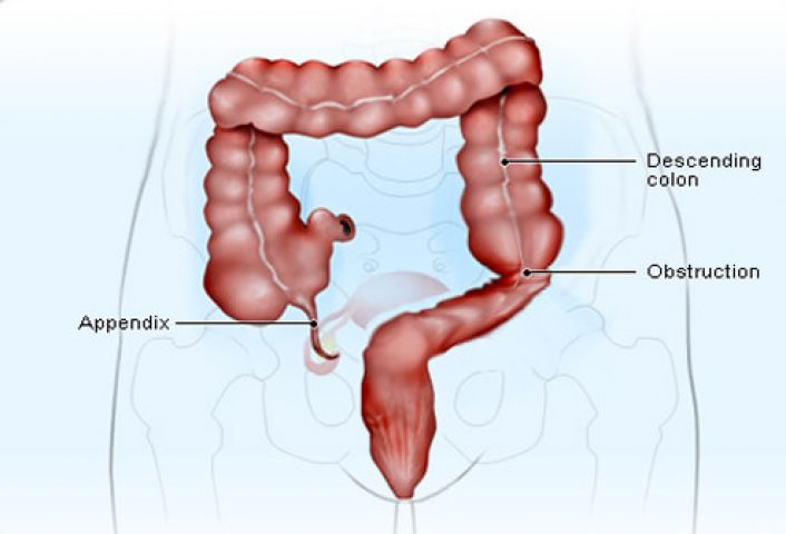 Here's What You Need To Know About Appendicitis!!!