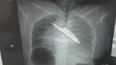 Knife removed from woman’s chest after 30 hours of stabbing