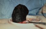 Woman diagnosed with a '14-Pound Hairball' in her stomach