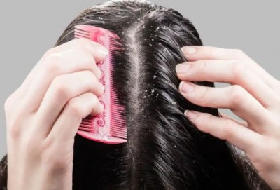How to Banish Dandruff, Adopt This Neem Remedy and Get Rid of It
