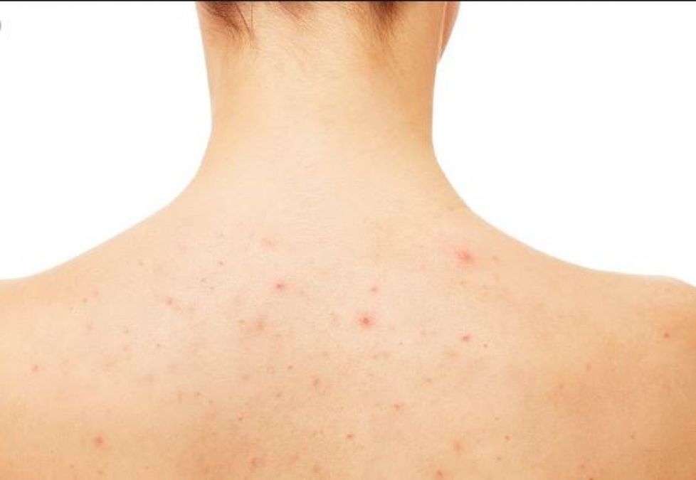 get-rid-of-back-acne-with-these-tips-newstrack-english-1