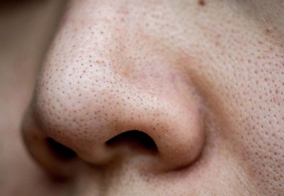 How to Easily Remove Blackheads? Tried and True Methods