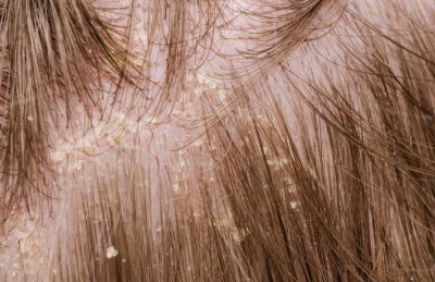 10 Common Causes of Dandruff You Should Know About