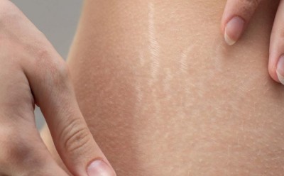 Follow These Simple Steps to Reduce Stretch Marks