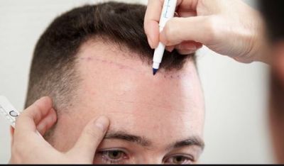 Keep these precautions in mind if you are going for Hair Transplantation