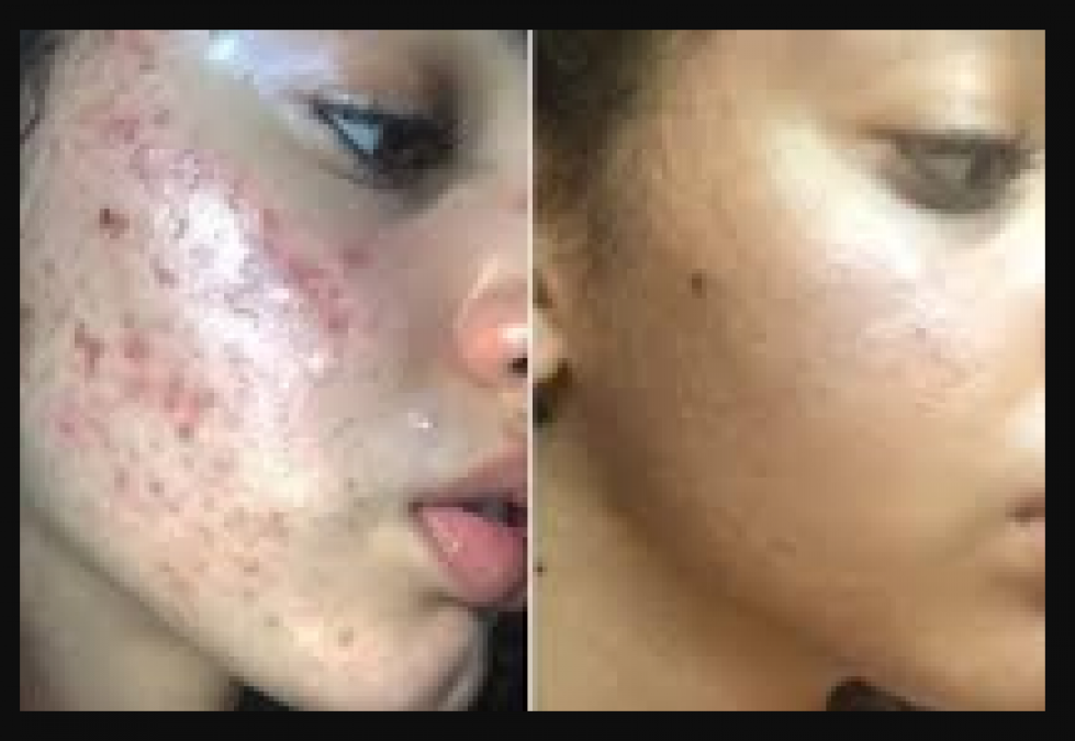 Use Salt To Get Rid Of Acne Or Pimples Know how NewsTrack English 1