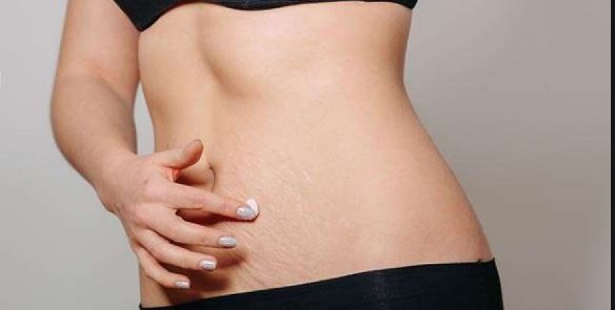 Troubled by stretch marks, try this