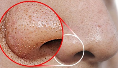 Troubled by Stubborn Blackheads on the Nose? Try These Tricks to Get Rid of Them