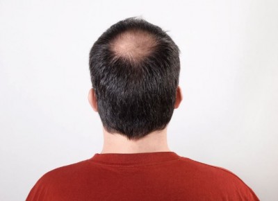 Prevent Baldness and Eliminate Hair Fall with These Three Things