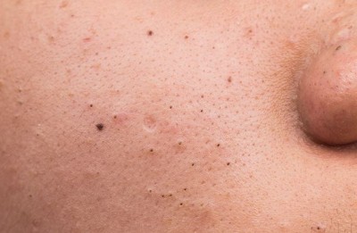 If You're Troubled by Stubborn Blackheads, Follow These Home Remedies to Get Rid of Them
