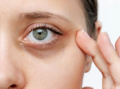 Can Excessive Sleep Cure Dark Circles? Discover the Truth Here