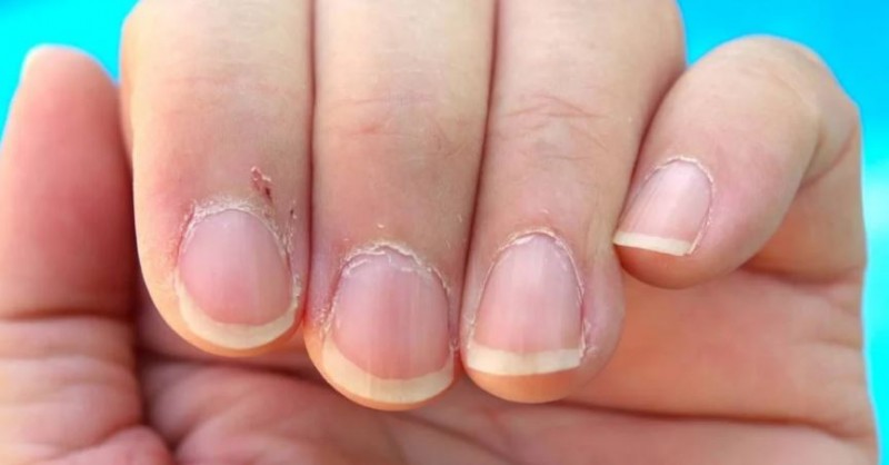Skin near the nails comes out again and again, then follow these tips