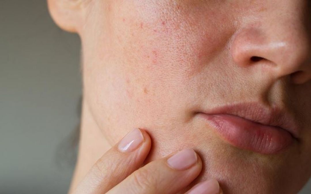 Tips To Remove Deep Acne Scars or Pimple Holes on Face | NewsTrack English 1