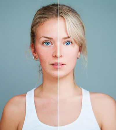 Photofacial is beneficial for Skin, know the advantages and disadvantages