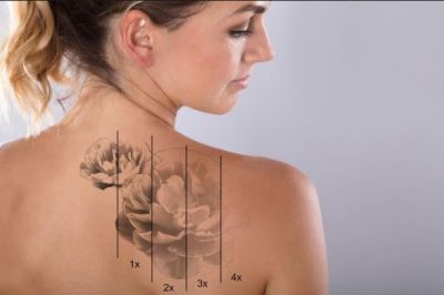 Are you going for Tattoo removals? Know some important thing before doing so