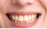 क्या पीलें दांत आपकी खूबसूरती पर लगा रहे है ग्रहण? तो ऐसे पाए छुटकारा