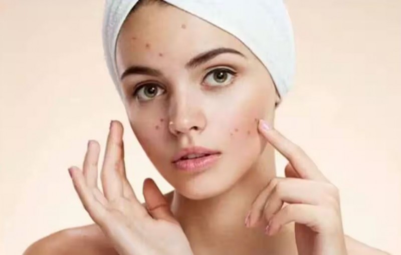 Bye-Bye Pimples: Home Remedies for a Flawless Complexion!