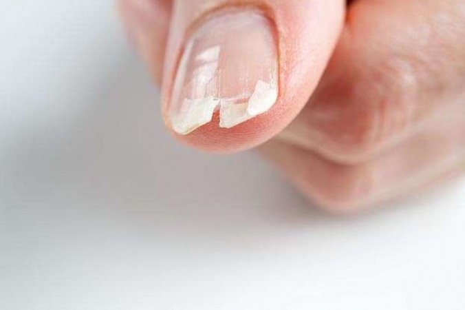 Nail Breakage Can Be Dangerous! How to Take Care