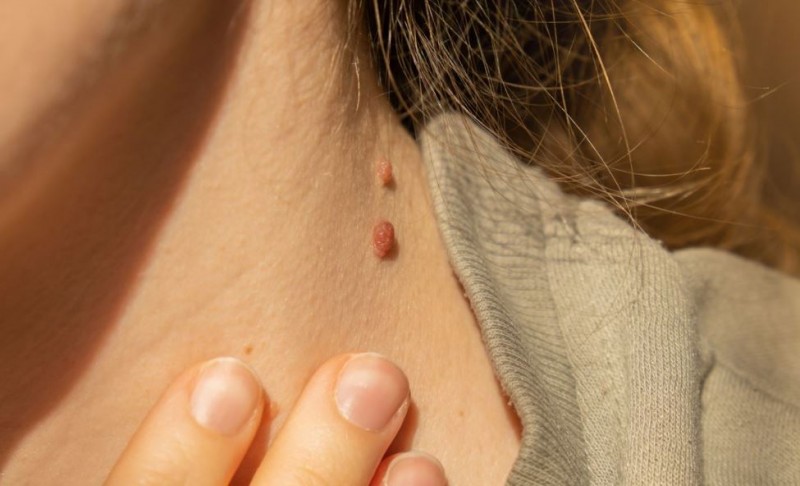 Have Warts Appeared on Your Neck and Underarms? Don't Ignore – They Could Indicate a Serious Health Condition