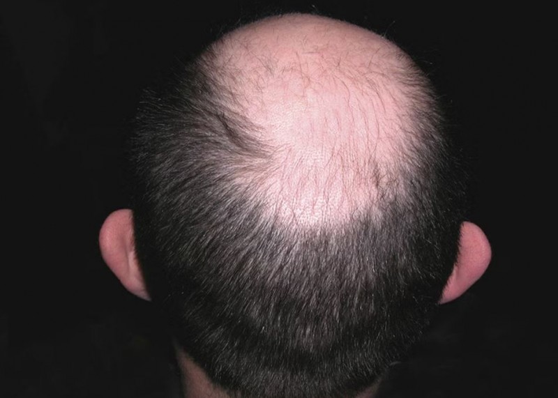 How to Stimulate Hair Growth on a Bald Scalp? Latest Research Findings Unveiled