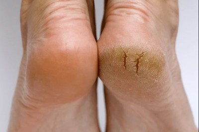 If Your Ankles Are Cracking, Do Not Ignore – It Could Be a Sign of These Diseases