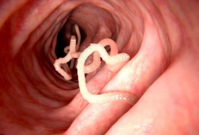 How to Determine if Worms are Present in the Stomach: Recognizing Symptoms and Treatment