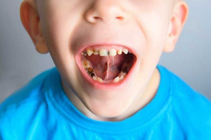 इस कारण बच्चों के दूध के दांत में लगते हैं कीड़े, इन उपायों को अपनाकर पाए छुटकारा