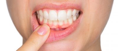 दांतों की समस्याओं को दूर करती है  नीम की पत्तियां