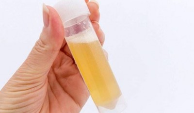These serious diseases can occur when froth appears in the urine