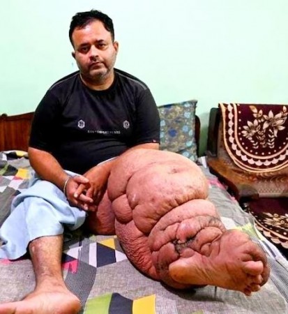 Due to a rare disease, the leg had become 50 kg, the operation went on for 90 hours
