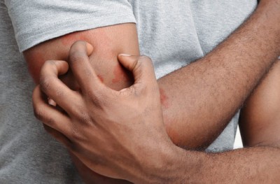 If itching is troubling you, then follow this remedy, you will get relief