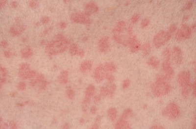 Do you have red rashes on your skin? Don't panic; follow these tips