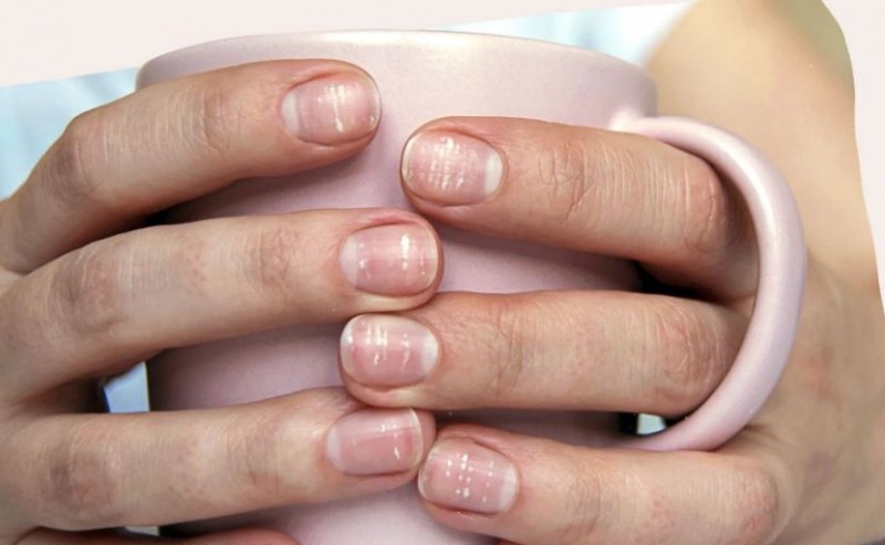 what-white-spots-on-nails-mean-and-how-to-get-rid-of-them