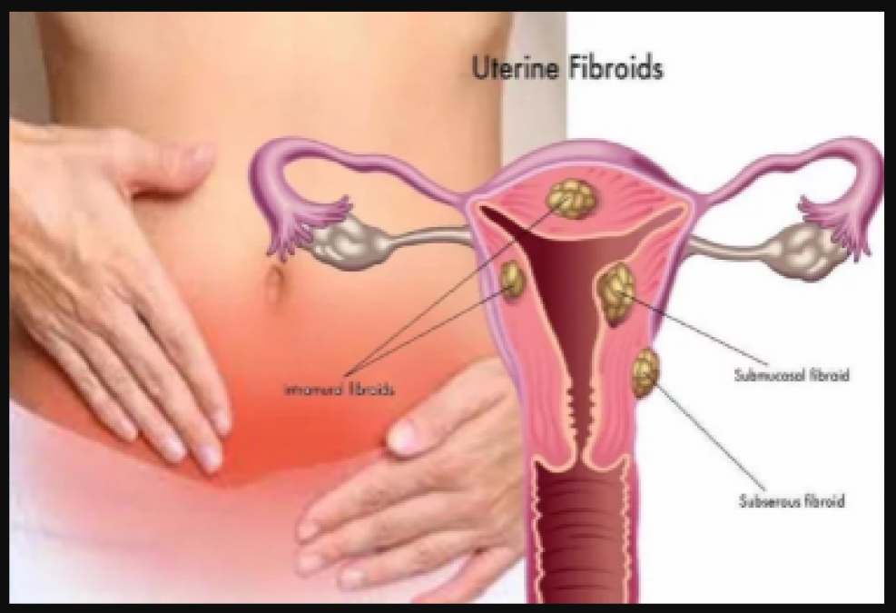 गर्भाशय में गाँठ के ये है लक्षण और इसका इलाज