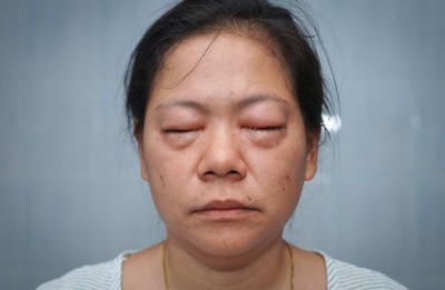 Do Not Ignore Facial Swelling Upon Waking Up - It Could Signify Serious Health Concerns