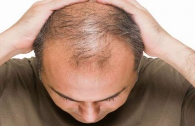 7 Reasons Why Men Experience Rapid Balding: Don't Ignore Them
