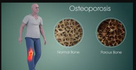 ऑस्टियोपोरोसिस डे : हड्डियों के कमजोर होने के पीछे ये कारण होते है जिम्मेदार, जाने