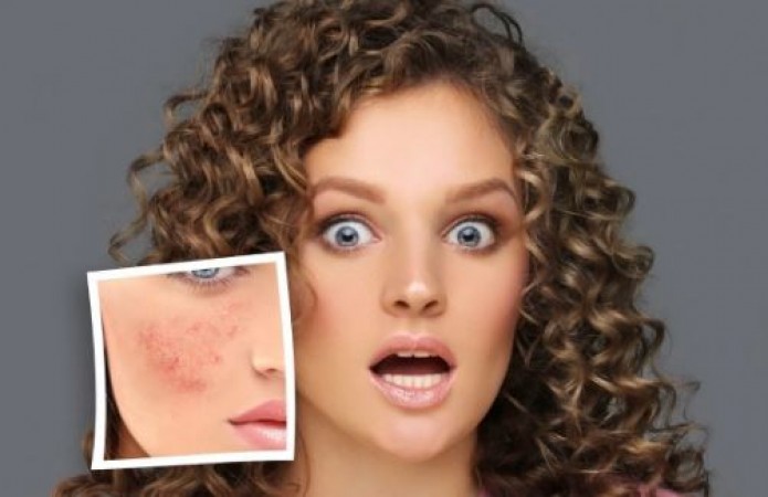 if-there-is-red-spot-on-face-then-adopt-these-home-remedies