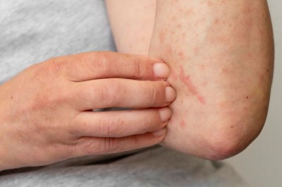 How to Get Rid of Skin Allergies? Adopt These Effective Remedies