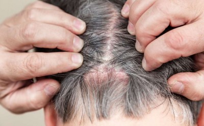 How to Use These 10 Effective Home Remedies to Relieve Scalp Itching