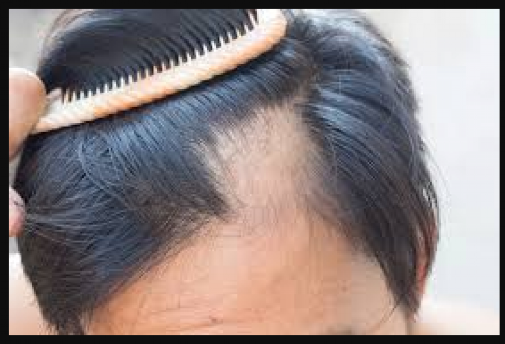 Problem of hair fall increases in winter, know how to get rid of it |  NewsTrack English 1