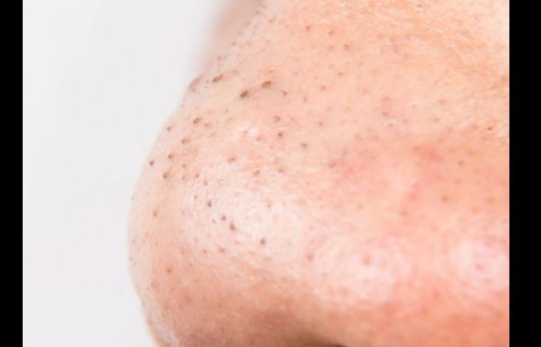 These home remedies will remove blackheads immediately