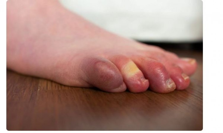 Swelling in toes in cold, mustard oil and black pepper will help