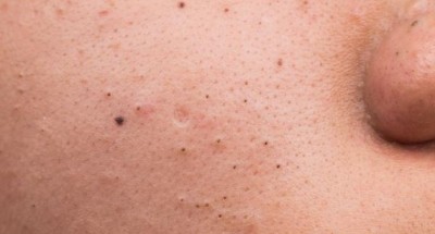 If you are also troubled by blackheads, then follow these home remedies