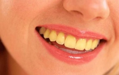 क्या आप भी है दांतों के पीलेपन से परेशान? तो अपना लें ये 3 घरेलू नुस्खे